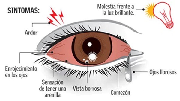 conjuntivitis