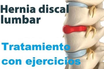 hernia de disco l5 s1