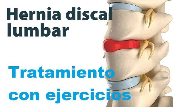 hernia de disco l5 s1